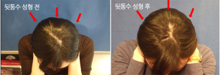 Illustration for article titled "Round Head" Plastic Surgery Seems Excessive, Even for South Korea
